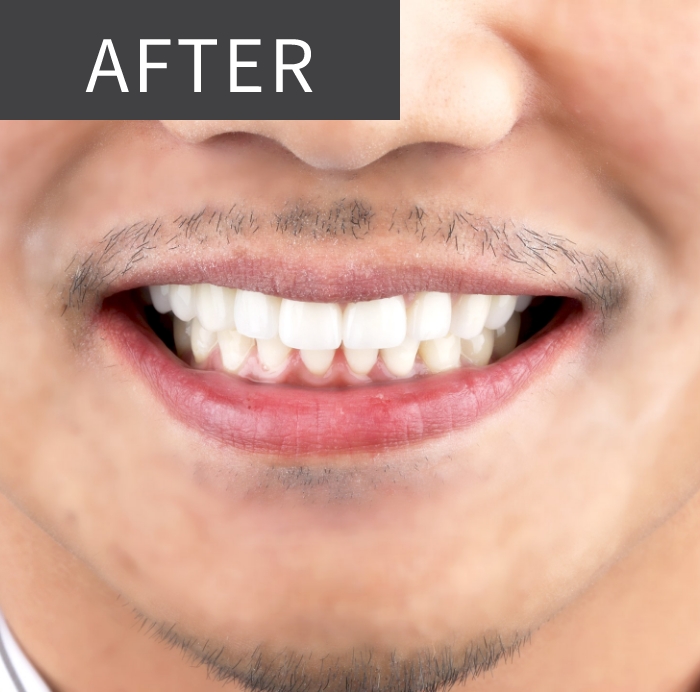After Treatment