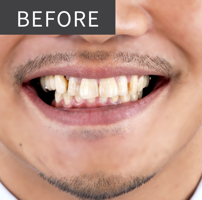 Before Treatment